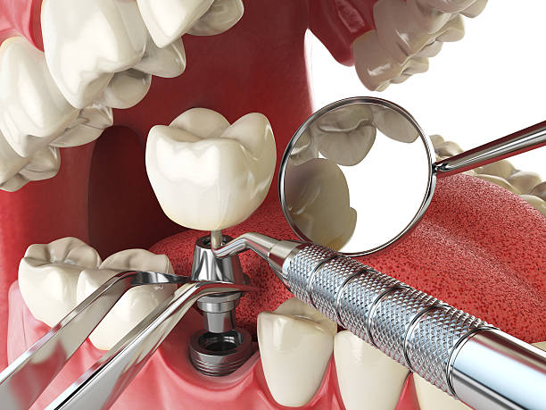 Best Chipped Tooth Repair Near Me  in Archie, MO